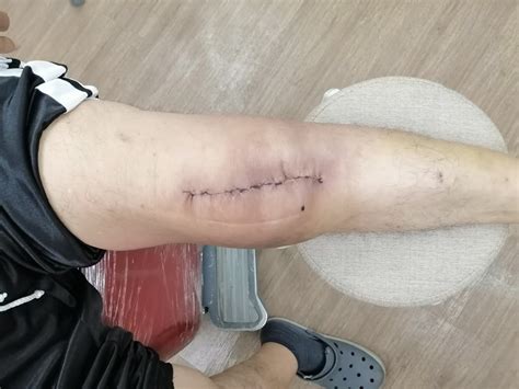 orthopedic doctor in iloilo city|Dr. Cleff Flores Orthopedic Clinic Page .